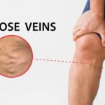 3 Top Treatments a Varicose Vein Specialist in Pikesville, Maryland Offers