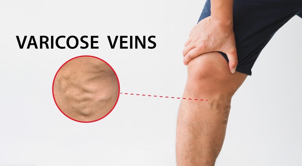 3 Top Treatments a Varicose Vein Specialist in Pikesville, Maryland Offers