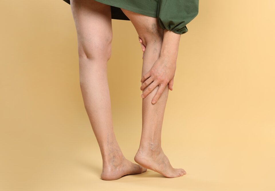 Free Consultation at the Best Varicose Vein Clinic