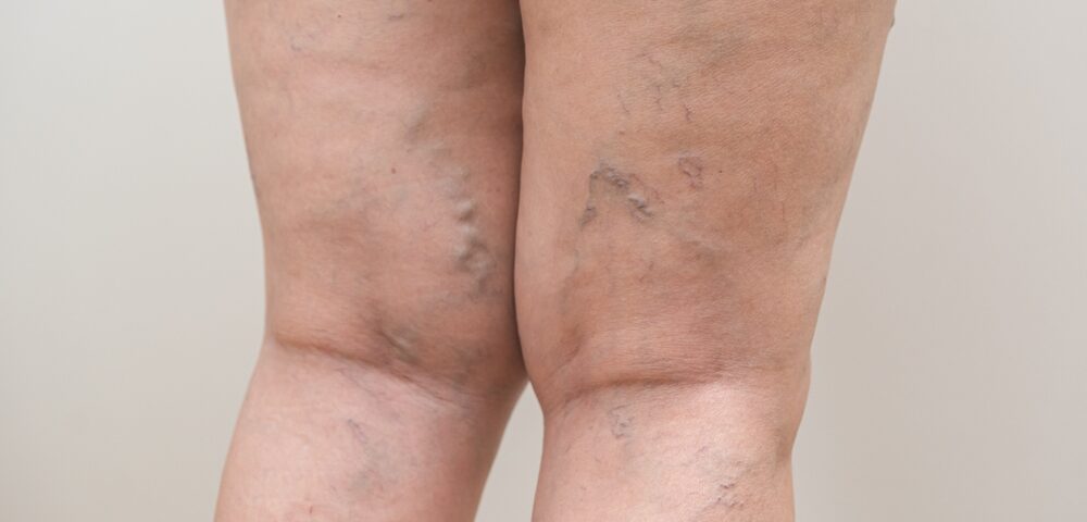 The Best Vein Doctor in Westminster Shares Spider & Varicose Vein Treatment Options