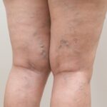 The Best Vein Doctor in Westminster Shares Spider & Varicose Vein Treatment Options