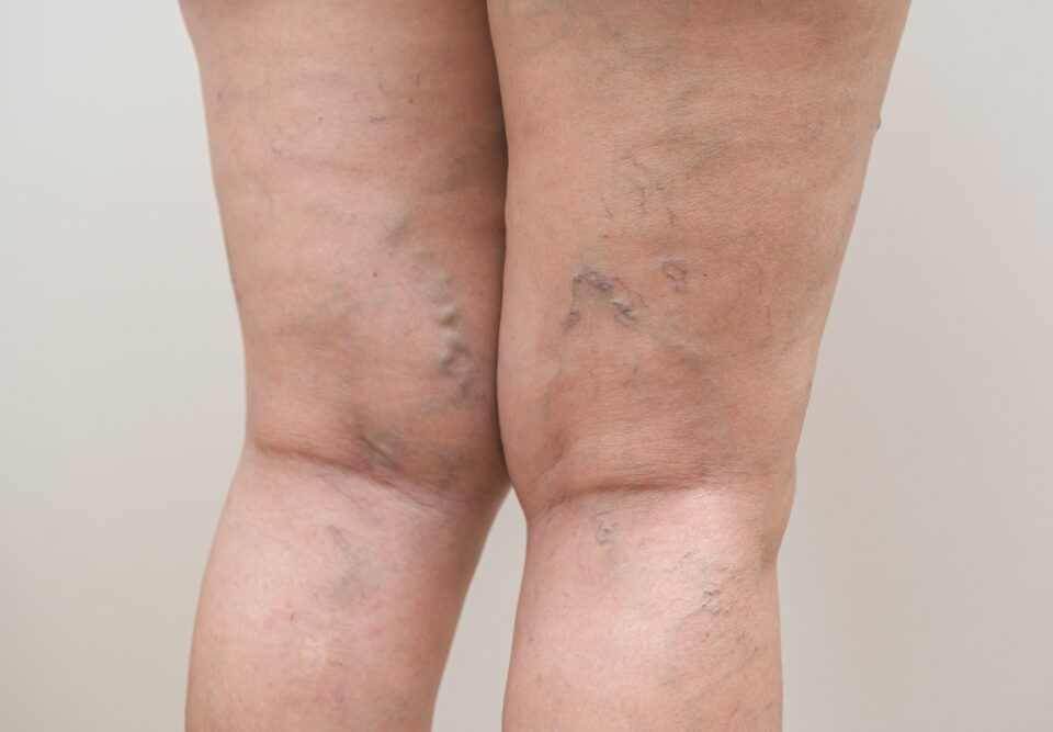 The Best Vein Doctor in Westminster Shares Spider & Varicose Vein Treatment Options