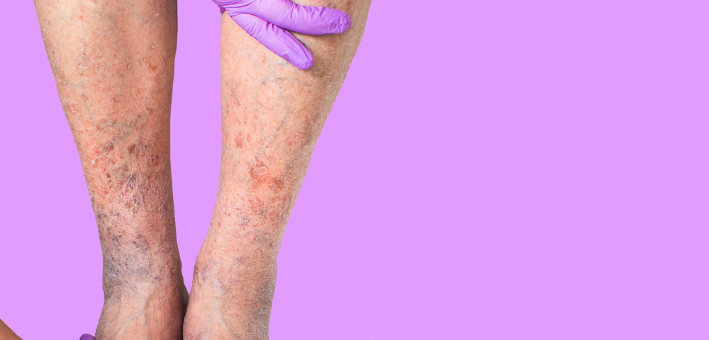 Same Day Varicose Vein Doctor in Cockeysville Maryland