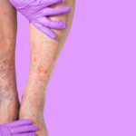 Same Day Varicose Vein Doctor in Cockeysville Maryland