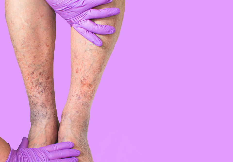 Same Day Varicose Vein Doctor in Cockeysville Maryland