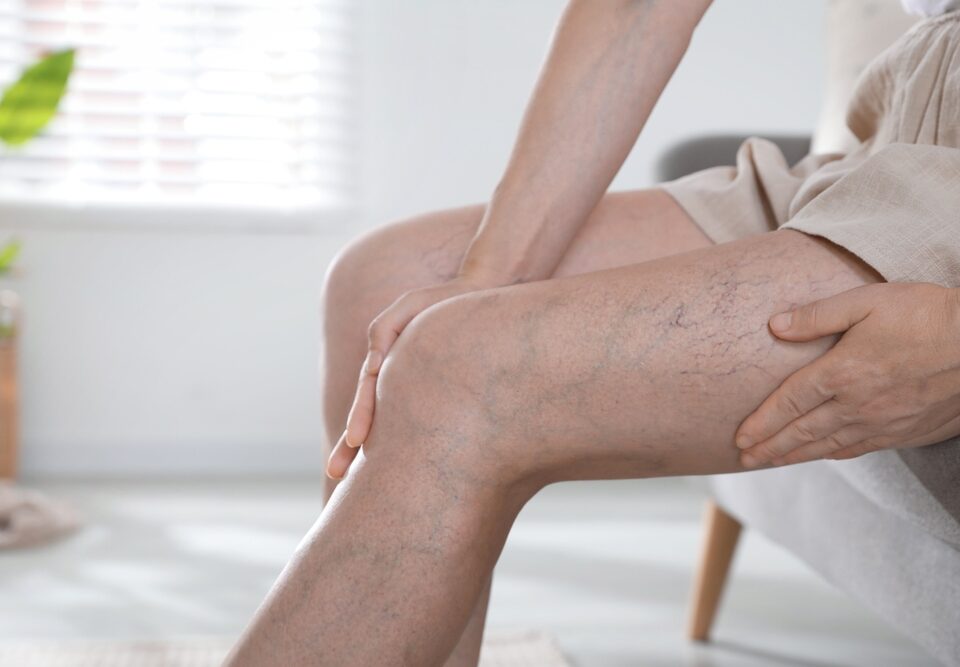 Why Do My Varicose Veins Hurt?