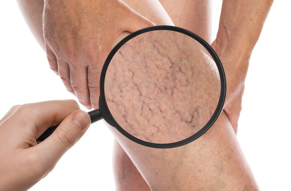 Do I Need a Vein Doctor in Pikesville, Maryland? 5 Signs It’s Time to Get Help