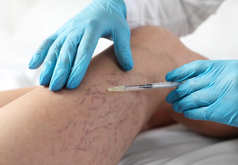 How Do I Find the Right Spider Vein Doctor in Owings Mills, Maryland?