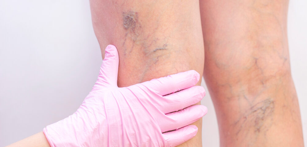 Emergency Leg Vein Specialists in Carroll County: Get Urgent Care Now