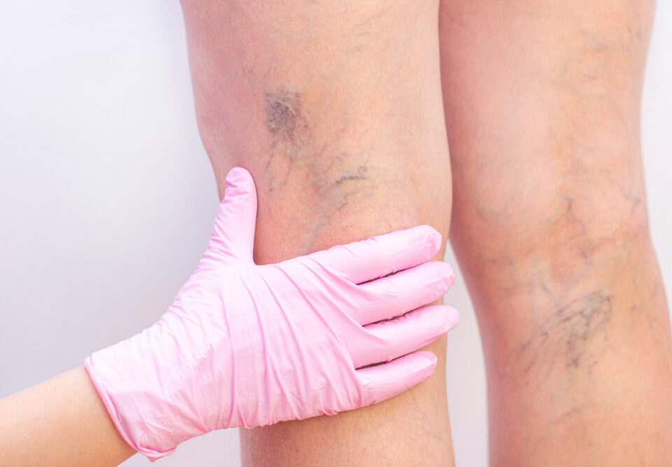 Emergency Leg Vein Specialists in Carroll County: Get Urgent Care Now