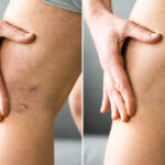 Where to Get Emergency Leg Vein Treatment in Eldersburg and Surrounding Carroll County