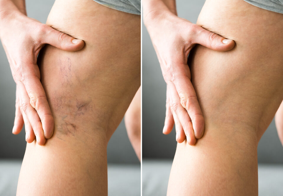 Where to Get Emergency Leg Vein Treatment in Eldersburg and Surrounding Carroll County