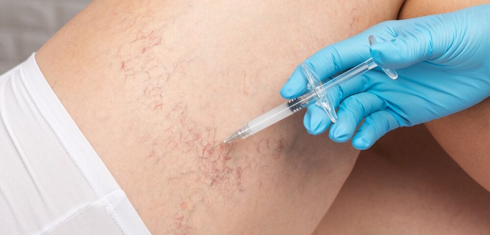 Urgent Care for Leg Veins: Fast Appointments in Sykesville and Eldersburg, MD