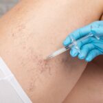 Urgent Care for Leg Veins: Fast Appointments in Sykesville and Eldersburg, MD