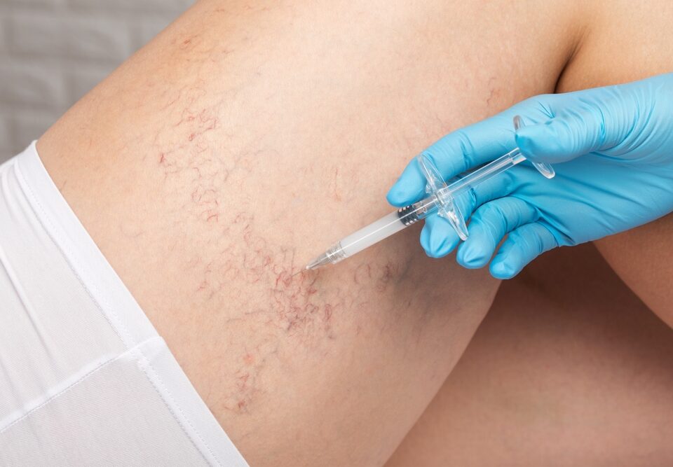 Urgent Care for Leg Veins: Fast Appointments in Sykesville and Eldersburg, MD