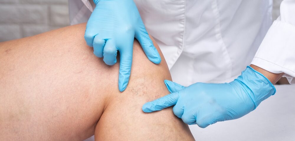 What You Should Know About Comprehensive Varicose Vein Treatments From the Best Doctors in Carroll County, MD and Surrounding Areas