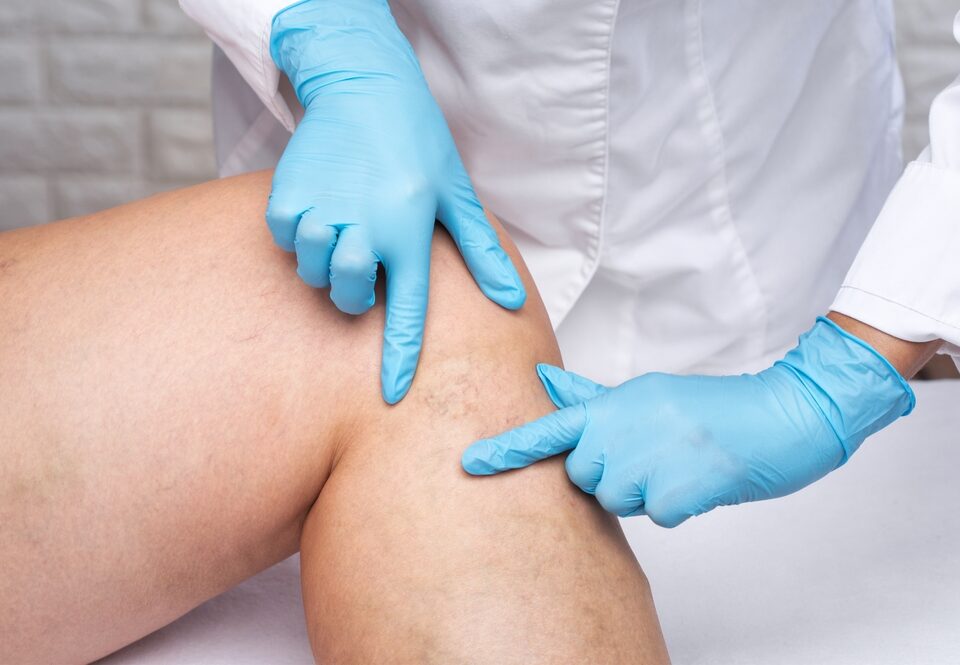 What You Should Know About Comprehensive Varicose Vein Treatments From the Best Doctors in Carroll County, MD and Surrounding Areas