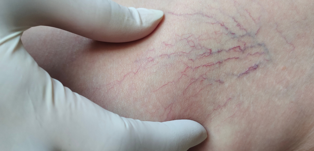 spider vein consultation Aberdeen