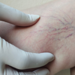 spider vein consultation Aberdeen