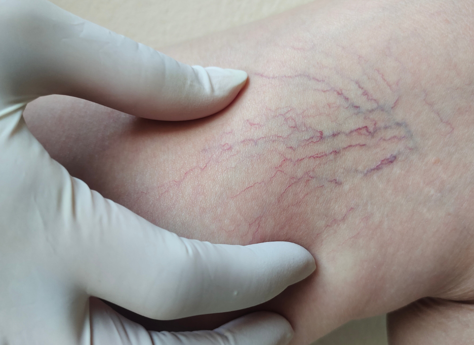 spider vein consultation Aberdeen