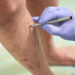 spider vein consultation Churchville