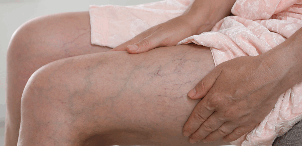 leg veins Forest Hills