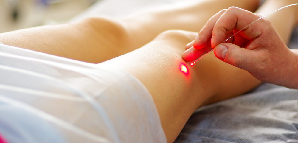 spider vein laser removal Edgewood MD