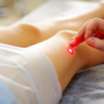spider vein laser removal Edgewood MD