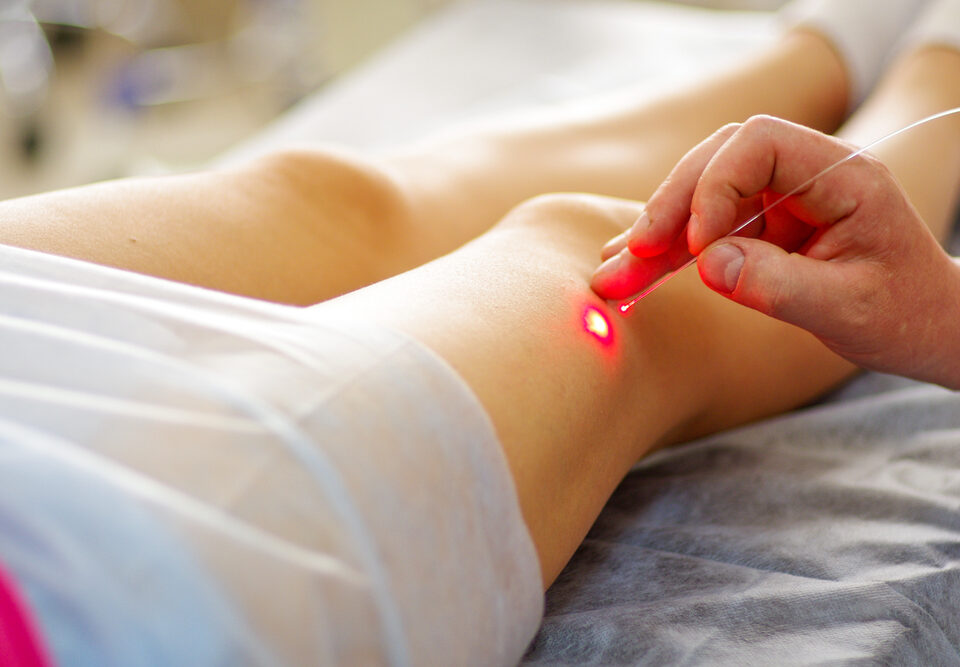 spider vein laser removal Edgewood MD