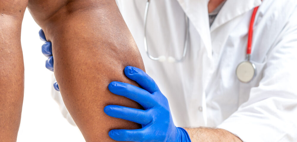 spider vein removal specialists near Abingdon MD