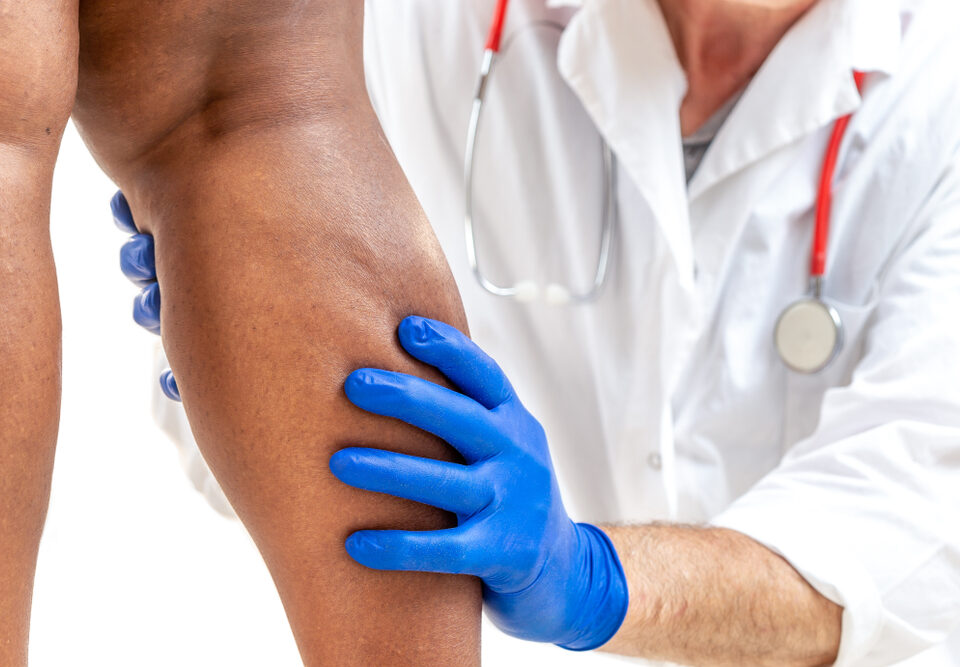 spider vein removal specialists near Abingdon MD