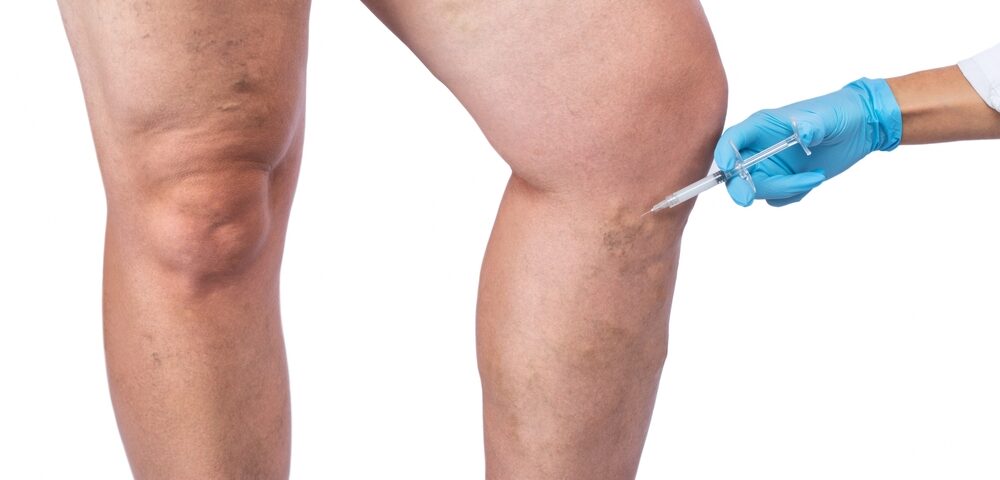 varicose vein treatment options available near Bel Air MD