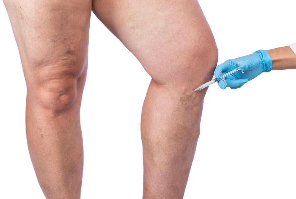 varicose vein treatment options available near Bel Air MD