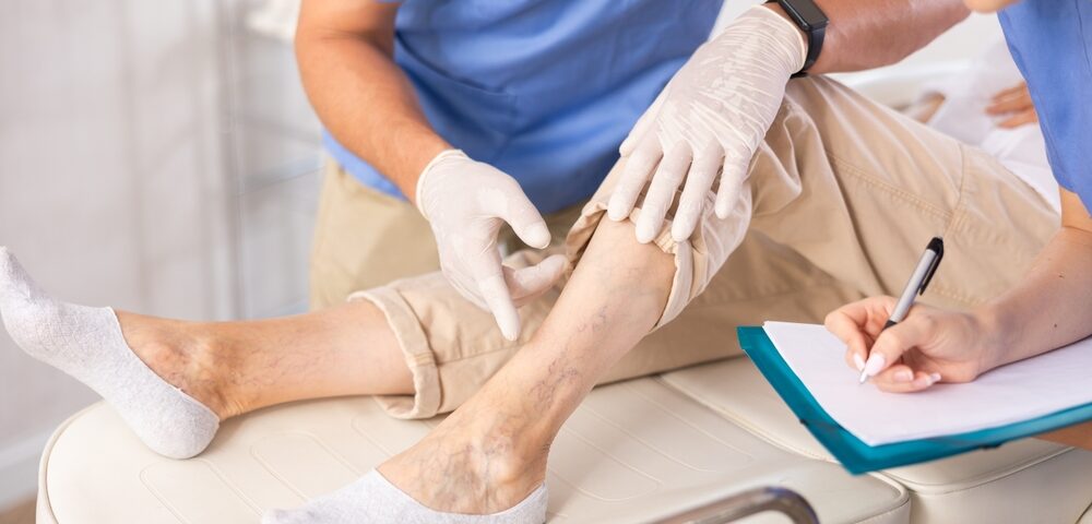 Free Vein Consultation Near Baltimore for Bulging Veins