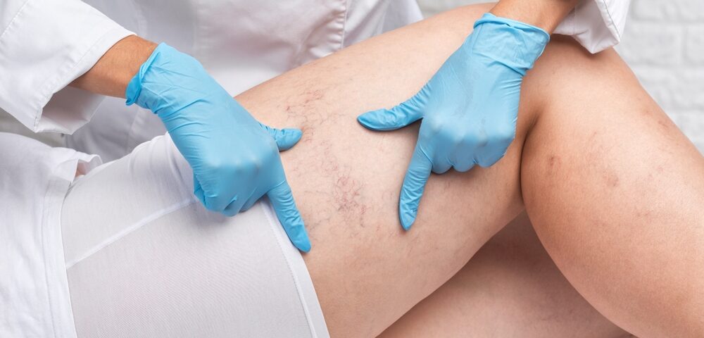 woman in early stages of chronic venous insufficiency