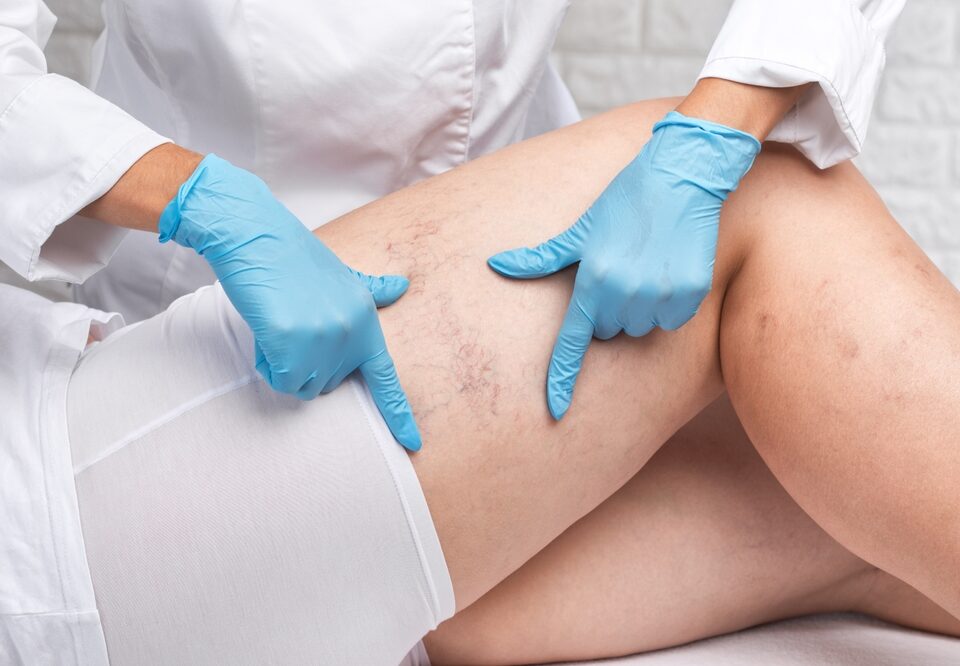 woman in early stages of chronic venous insufficiency