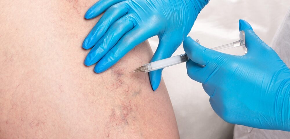sclerotherapy in MD