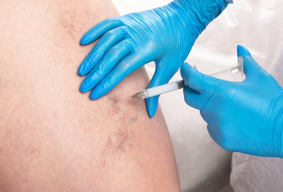 sclerotherapy in MD