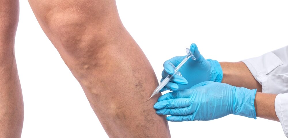 vein treatment Columbia Maryland