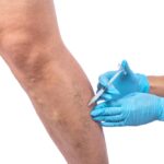 vein treatment Columbia Maryland