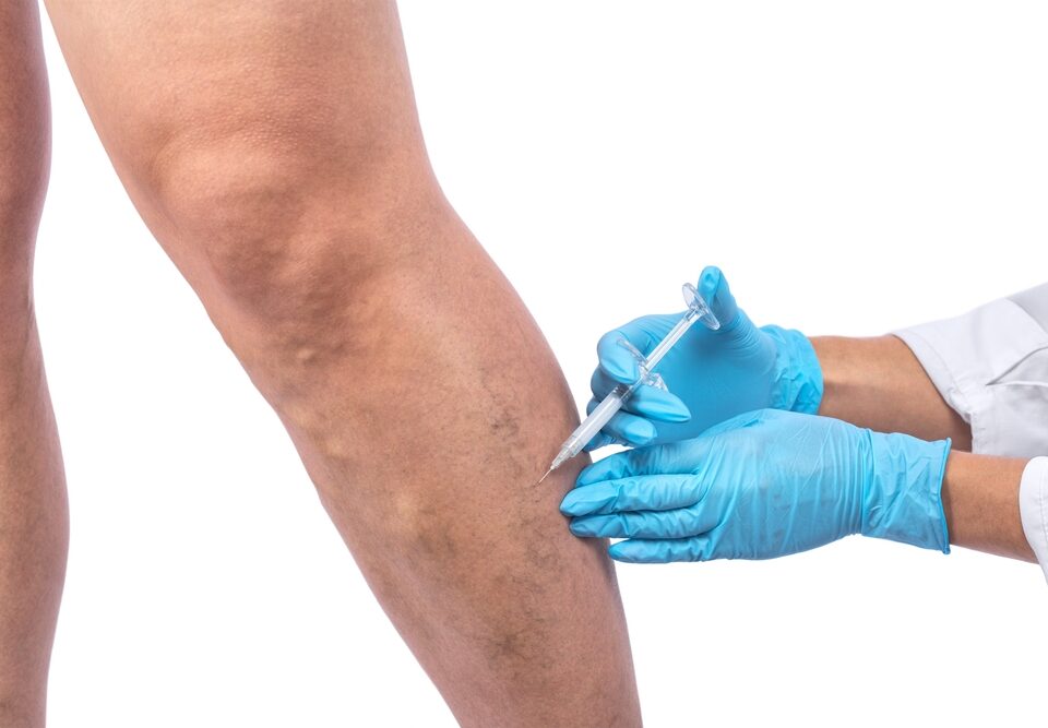 vein treatment Columbia Maryland