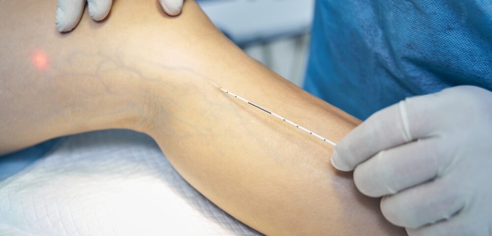 woman getting fast relief from spider veins in Bel Air Maryland
