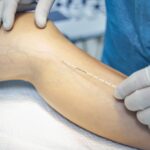 woman getting fast relief from spider veins in Bel Air Maryland