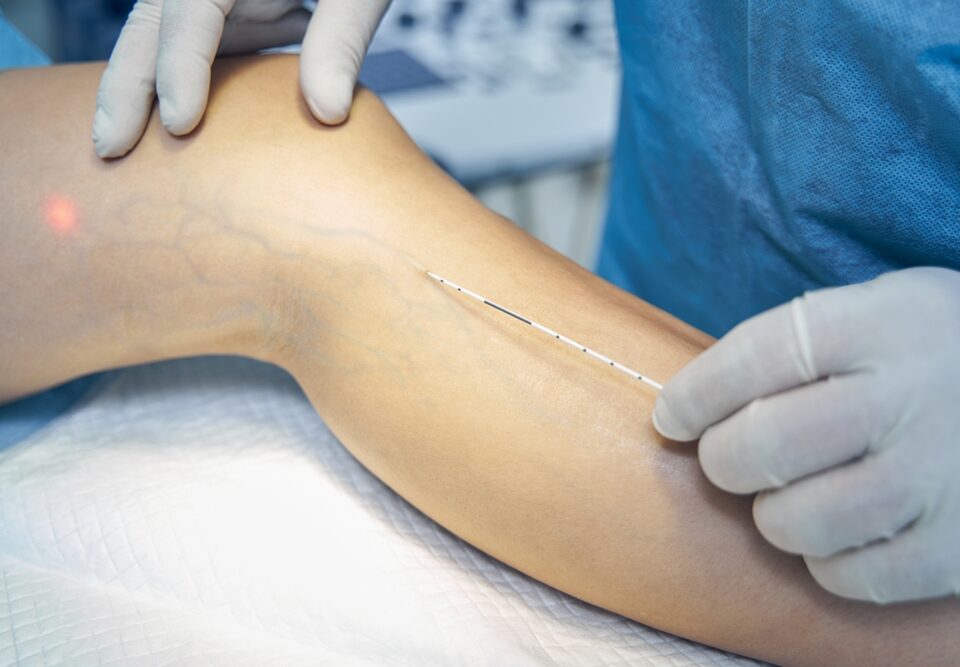 woman getting fast relief from spider veins in Bel Air Maryland