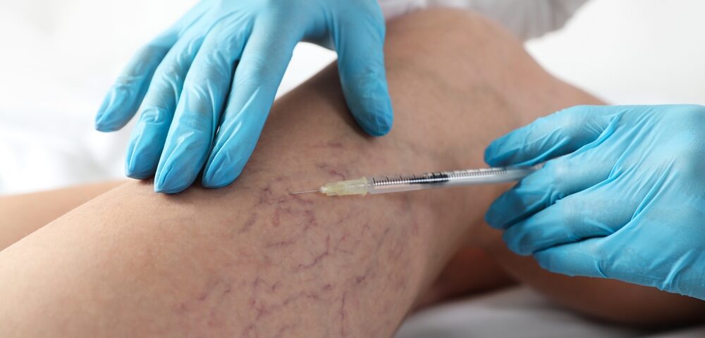 Minimally Invasive Vein Care Solutions in Edgewood MD