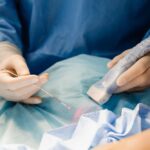 ultrasound-guided foam sclerotherapy in bel Air Maryland