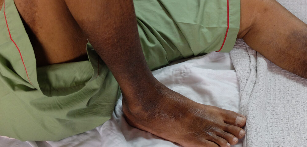 patient with CVI in Baltimore Maryland