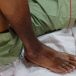 patient with CVI in Baltimore Maryland