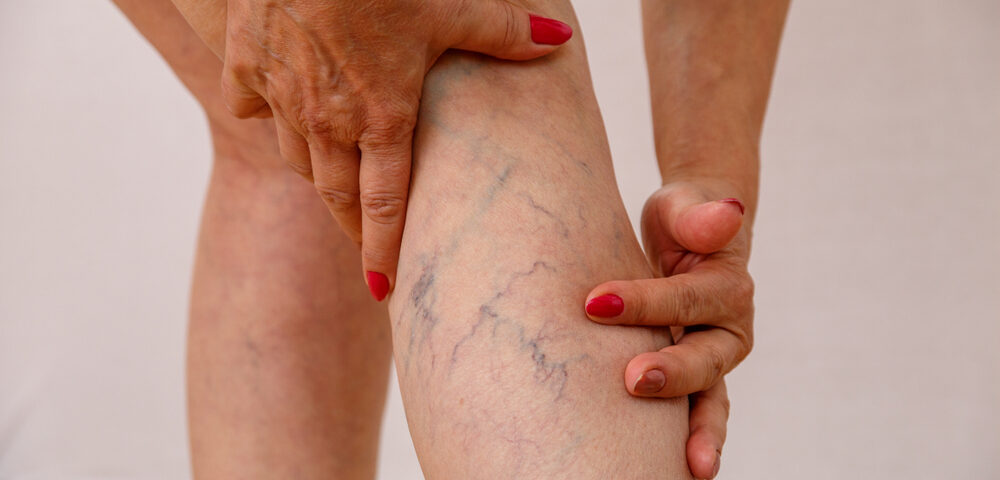 woman with Peripheral Venous Disease in Maryland