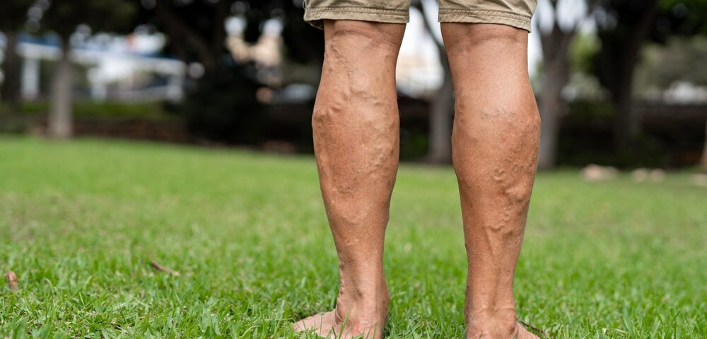 vein conditions in men
